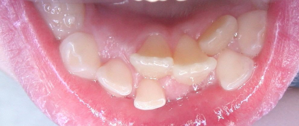 Unregelmäßig stehende bleibende Schneidezähne in der Ugly-Duckling-Phase des Zahnwechsels bei einem 8 Jahre alten Kind