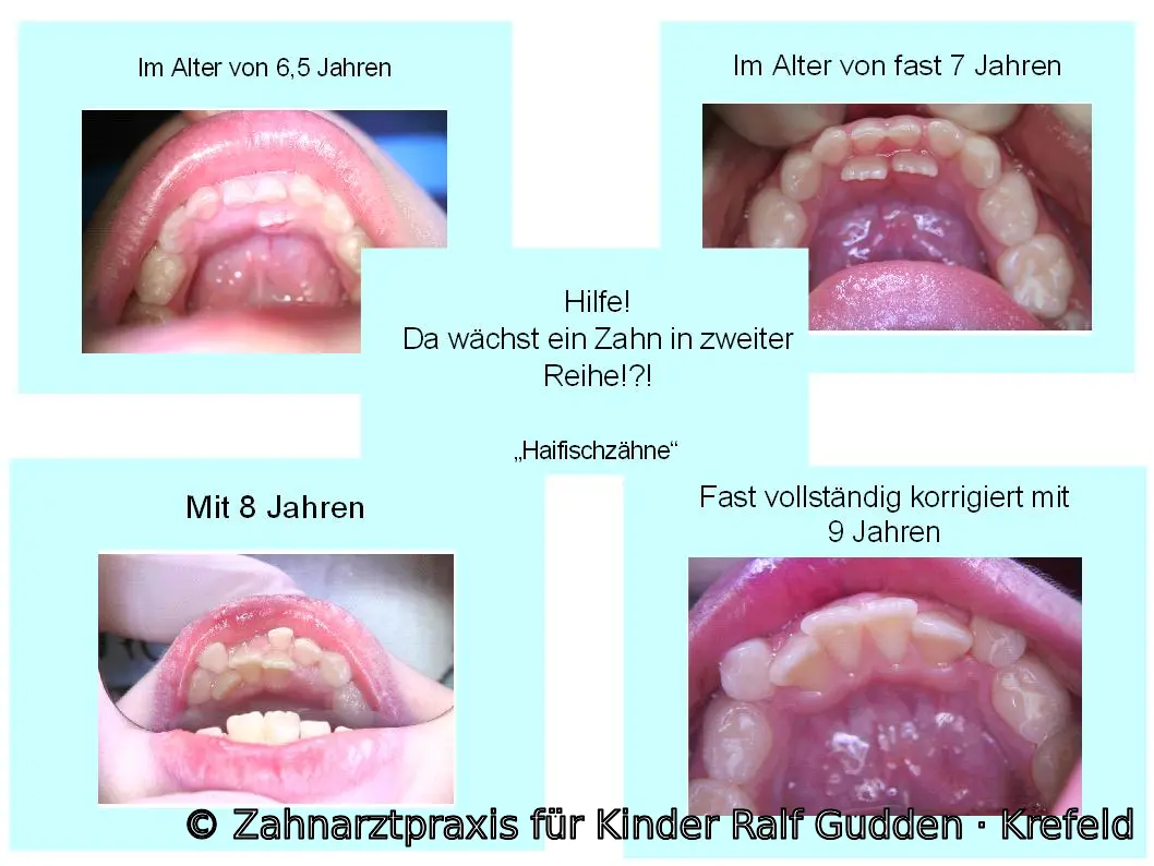 Vier Verlaufsbilder eines Haifischzahns beim Kind im Alter von 6,5 Jahren, fast 7 Jahren, 8 Jahren und 9 Jahren