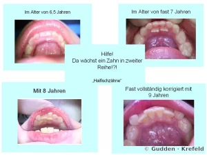 Fotodokumentation zum Verlauf von Haifischzähnen bei einem Kind