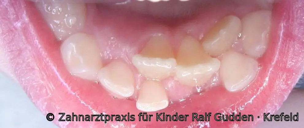 Unregelmäßig stehende bleibende Schneidezähne in der Ugly-Duckling-Phase des Zahnwechsels bei einem 8 Jahre alten Kind